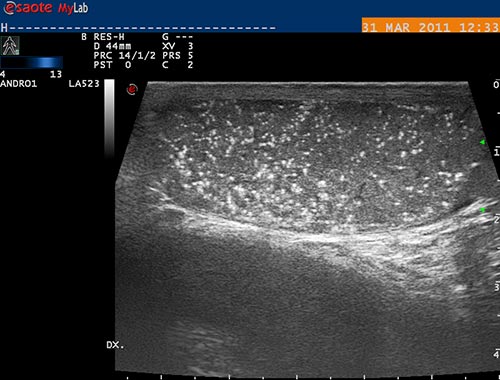 testikul�rn� azoospermie, mikroliti�za varlete