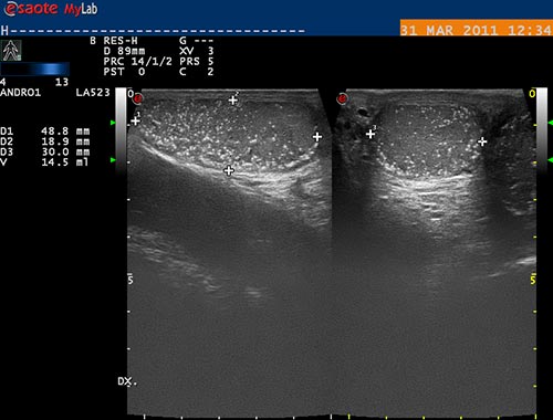 testikul�rn� azoospermie, mikroliti�za varlete, volumometrie
