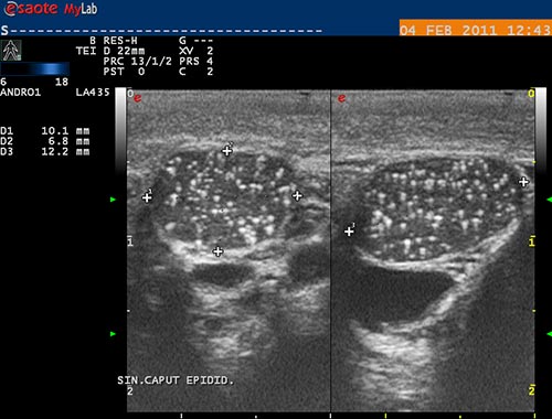 obstruk�n� azoospermie, spermatok�la p�i dlouhotrvaj�c� obstrukci