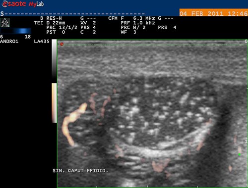 obstruk�n� azoospermie, dif. dg. tumor hlavy epididymis - avaskul�rn� �tvar - spermatok�la -Power Doppler