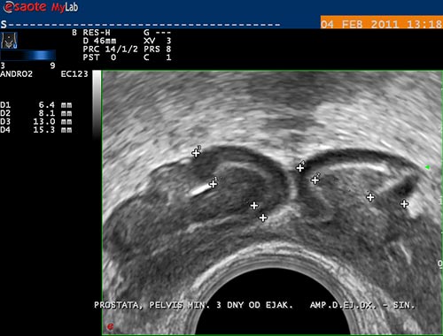 obstruk�n� azoospermie, dilatace semenn�ch v��k�, oboustrann� obstrukce ductus ejaculatorii, TRUS