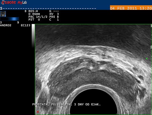 obstruk�n� azoospermie,oboustrann� obstrukce ductus ejaculatorii, transverz. �ez, TRUS