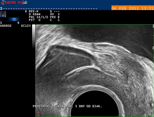 obstruk�n� azoospermie, obstrukce ductus ejaculatorius - parasagit�ln� �ez, TRUS