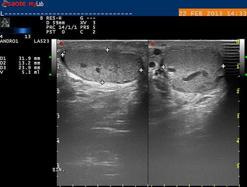 testikul�rn� azoospermie ,hypotrofie testis s intratestikul�rn� varikok�lou