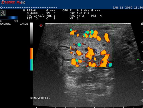 intratestikul�rn� varikok�la vestoje IAP CFM Doppler